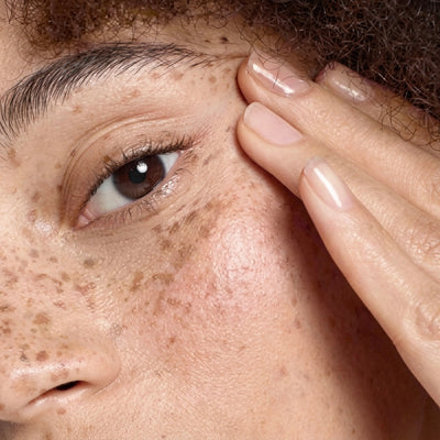Hyperpigmentation