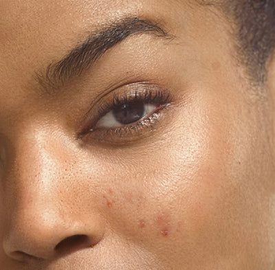 Blemish